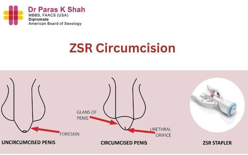 zsr circumcision in ahmedabad